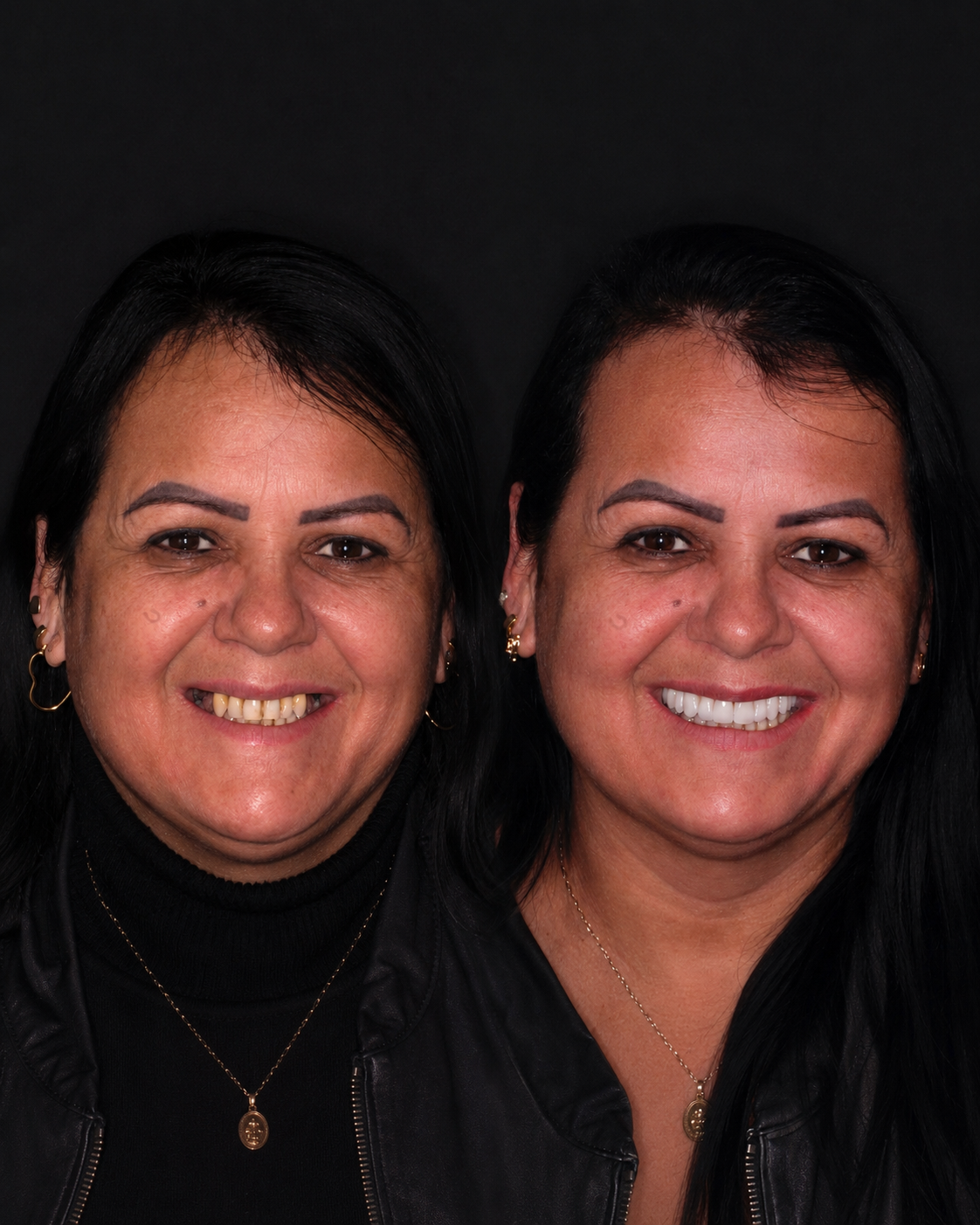 Caso real de implante — antes e depois (paciente feminina)