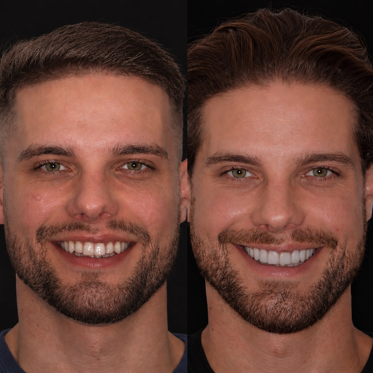 Caso real de implante — antes e depois (paciente masculino)