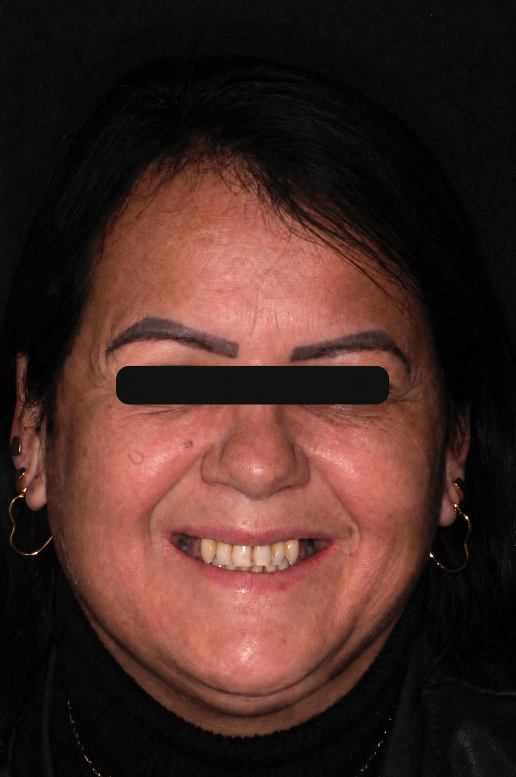 Paciente antes do tratamento — impacto da perda dentária no sorriso